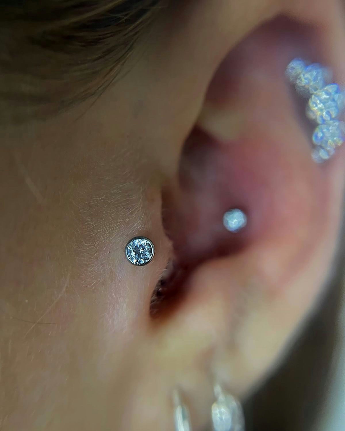 Curación de lóbulo y anti-tragus